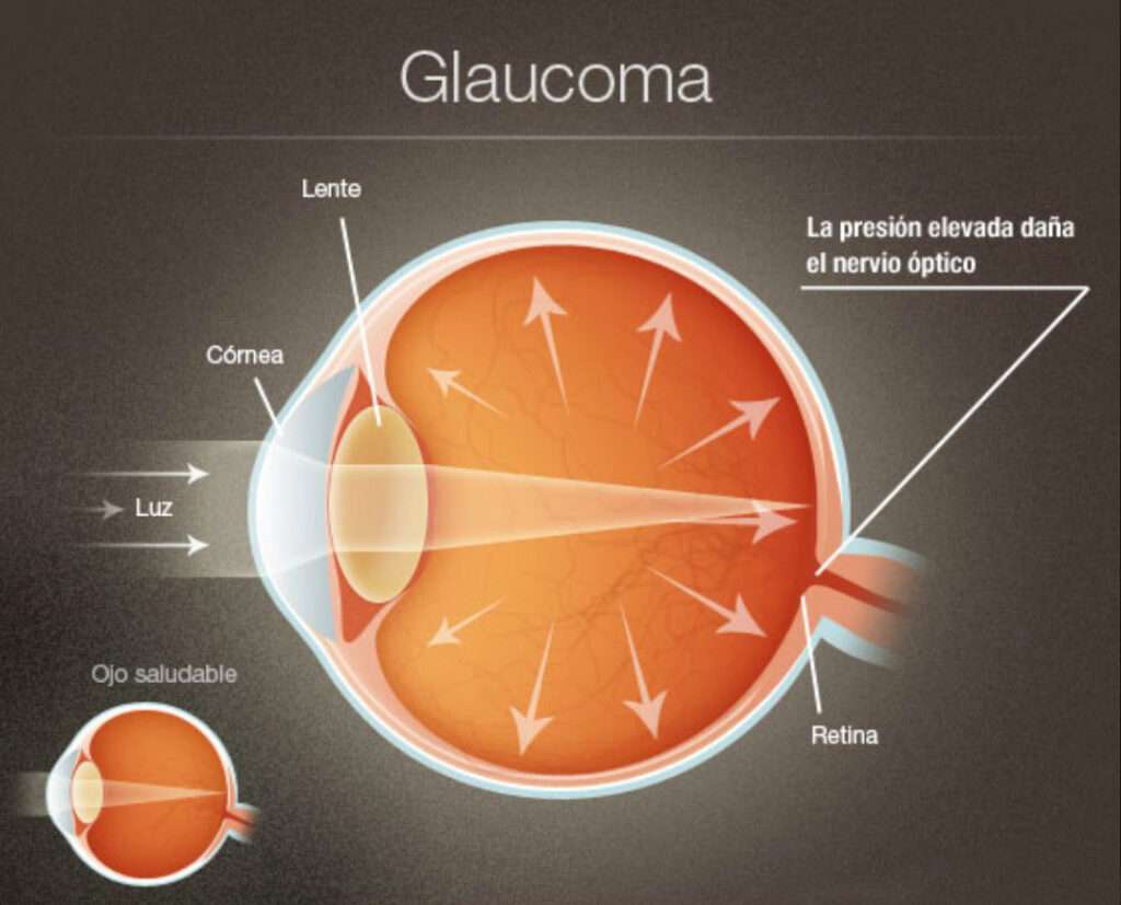 Glaucoma Clínica Carrasco Mataix Sevilla 2411
