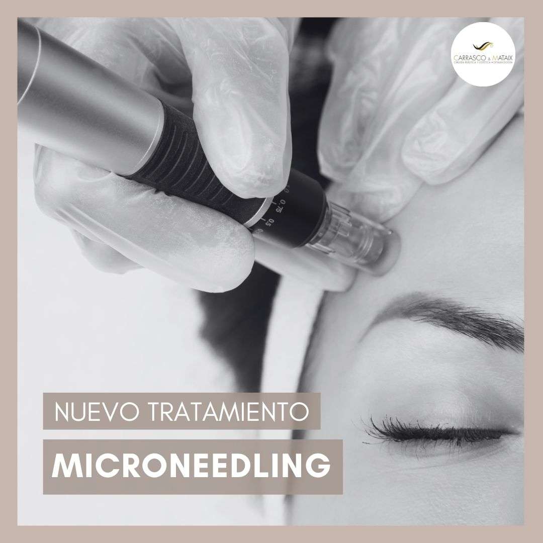 Nuevo Tratamiento Microneedling Clínica Carrasco Mataix Sevilla 7402